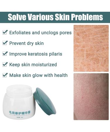 Keratosis Pilaris Cream Keratosis Pilaris Treatment Chicken Skin Smoothing Cream Body Soothing Chicken Skin Treatment Body Care Cream for Rough Bumpy Skin 50g/1.8 oz - Buy Online on GoSupps.com