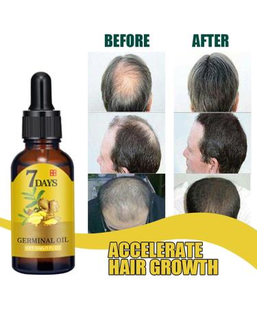 S rum de Croissance des Cheveux au Gingembre Hydrate La Pousse Des Cheveux S rum Croissance Cheveux S rum Pousse Cheveux Tr s Rapide pour Les Cheveux Fins Pr vention de La Chute des Cheveux 20ML - Buy Online on GoSupps.com