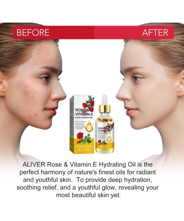 Vitamin E Oil - Rose Face & Body Oil for Dry Skin Wrinkle Reduction Scars Stretch Marks | Gentle Formula - 2.02 Oz - Buy Online on GoSupps.com
