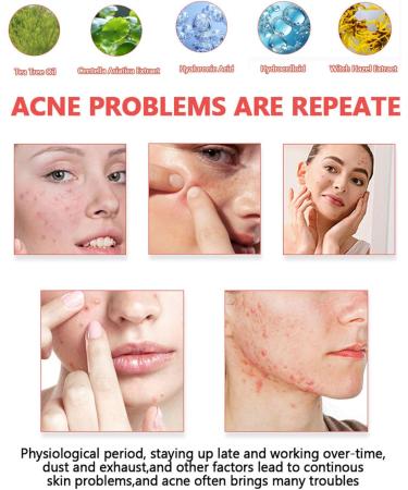 CHEMISTRY 200 pieces pimple patches colorful pimple patch hydrocolloid patches with tea tree oil salicylic acid hydrocolloid patches day and night use waterproof breathable acne patches - Buy Online on GoSupps.com