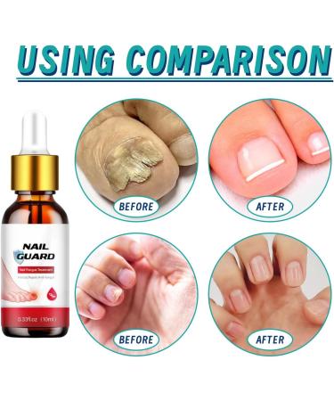 Fungal Nail Treatment for Toenail Toe Nail Fungal Treatment Anti Fungus Nail Repair and Strengthen Toenail Fungus Treatment Fungal Nail Drop Fix and Renew Damaged Cure Nail Fungus Restoring Nails - Buy Online on GoSupps.com