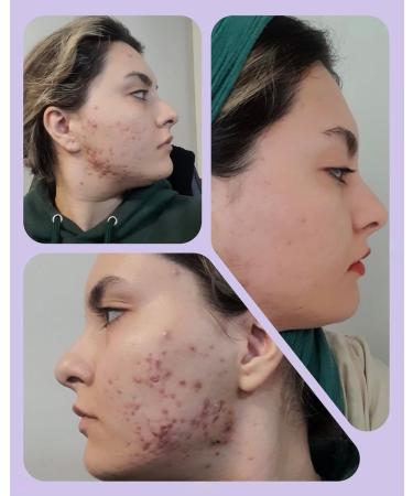 Demodexcillin Demodexcillin Skin Solution 4.0 Fl.Oz. Recommended for Rosacea Acne Belpharitis & Seborrheic Dermatitis - Buy Online on GoSupps.com