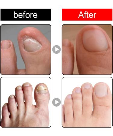 Ingrown Toenail Treatment Fungal Nail Treatment Ingrown Toenail Drops Nail Care and Treatment Strengthen Renew Damaged Nail(30ML) - Buy Online on GoSupps.com