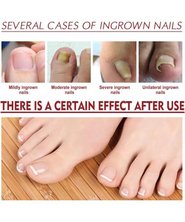 Ingrown Toenail Treatment Correction Drops Nail Growth Treatment Nail Care Ingrowing Toenail Treatment Ingrown Toenail Corrector Treatment for Ingrown Toenail Ingrowing Toenail Improve Toenail Health - Buy Online on GoSupps.com