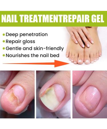 Narc Lot de 2 gels de r paration pour ongles Paronychia gel r parateur pour ongles et ongles ab m s 2Pcs - Buy Online on GoSupps.com