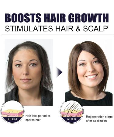 Ginger Hair Growth Mist Hair Growth Serum Herbal Mist for Hair Regrowth Natural Nourishing Scalp Mist for Hair Loss - Buy Online on GoSupps.com