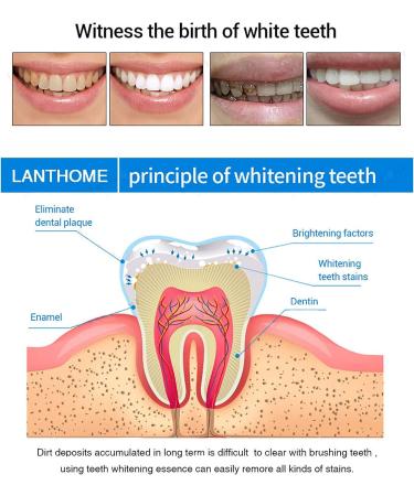LANTHOME Teeth Whitening Kit - 3Pcs Essence, Pen, Deluxe Set | Intensive Stain Removal and Yellowing Reduction | Oral Care Products - Buy Online on GoSupps.com