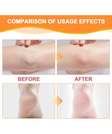 BROEYOUE Moisturizing and anticracking foot cream foot care cream for dry feet moisturizing and anticracking foot cream moisturizes for dry hands and feet 2 pieces - Buy Online on GoSupps.com