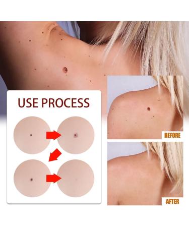ZRREMRE Skin Flaps and Birthmark Remover Wipe Away Skin Flaps and Birthmarks 3 Pack Extreme Removal Instant Painless Removal for Skin Warts and Birthmarks - Buy Online on GoSupps.com