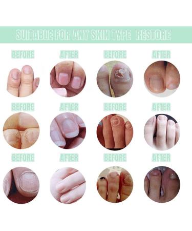 Buy Nail Care Pen Set | 2 Pieces Nail Hardener & Treatment for Healthy Nails - Fast & Effective Repair for Broken Nails & Fungal Infections - Buy Online on GoSupps.com