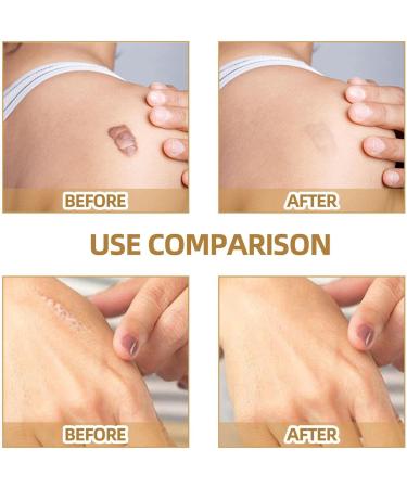 2 60 Pimple Up Stickers | Skin Scar Patches Waterproof | Waterproof Skin Tone Invisible Sticker Skin Concealing Patches 60 2 Pcs 60patch/Box - Buy Online on GoSupps.com