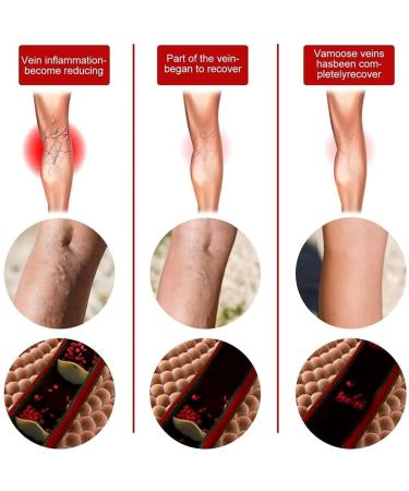 Buy Varicose Vein Treatment Soap - Ginger Infused Wood Soap for Smooth Skin (1 Piece) - International Shipping Available - Buy Online on GoSupps.com