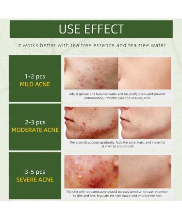 ARCHIDATE Acne Removing Face Cream Natural Formula Herbal Acne Cream for Oily Prone Combination Skin Reduce Pimples Blemishes Blackheads Clean and Purify Pores Control Oil Soothe & Calm Skin - Buy Online on GoSupps.com