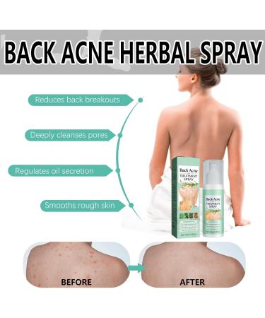Back Acne Treatment Spray Acne Treatment Spray Acne Moisturiser for Back Body Body Acne Treatment Acne Back Treatment Back Spray Acne Body Acne Spray Back Acne Treatment Acne Body Spray 120ml - Buy Online on GoSupps.com