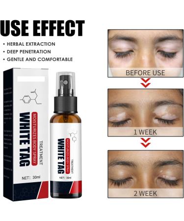 KOAHDE Psoriasis Treatment Spray Vitiligo Relief Spray Psoriasis Control Face and Body Cream Soothing and Moisturizing Coal Tar Psoriasis Cream Spray Psoriasis Control White Spot Spray 30ml 1PC - Buy Online on GoSupps.com