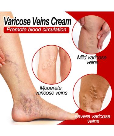 Varicose Veins Cream Spider Vein Cream Varicose Veins Treatment for Legs Spider Veins Treatment Cream Vein Cream for Legs Spider Veins Repair Cream Varicose Veins Ointment Aching Legs Relief - Buy Online on GoSupps.com