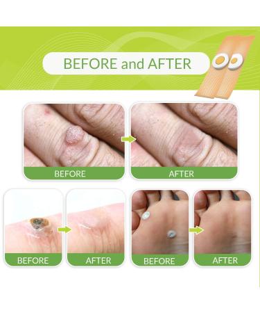 TXL Active Wart Remover | Potent Treatment for Wart Removal (30 Pads) | NDC Code 83124-003-01 - Buy Online on GoSupps.com