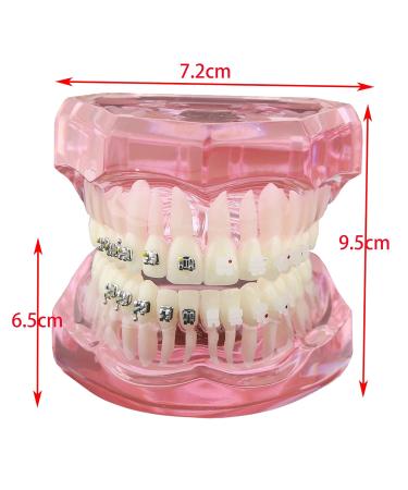Buy Dental Orthodontic Teeth Model with Metal & Ceramic Brackets - Ideal for Study & Research | International Shipping Available - Buy Online on GoSupps.com