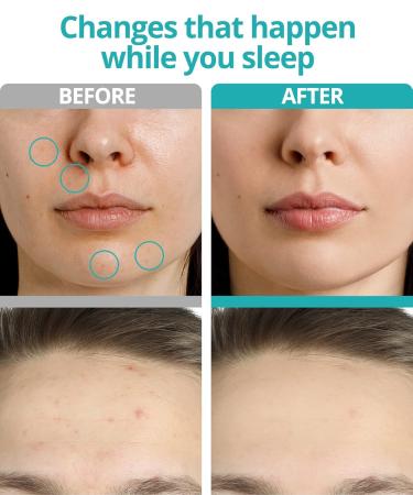 Buy Microdart Blemish Patches - 27 Fast Acting Zit Patches for Cystic Acne - Infused with Hyaluronic Acid & Tea Tree - International Shipping Available - Buy Online on GoSupps.com