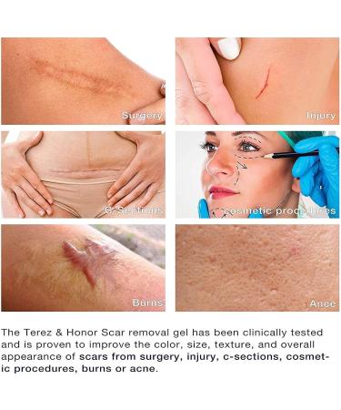 Scar Removal Gel Advanced Silicone Scar Gel Scar Removal Cream for New and Old Scar Repair Stretcher Remover - Buy Online on GoSupps.com