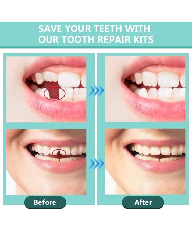Temporary Tooth Repair Kit with Mouth Mirror and Dental Tools - Restore Missing or Broken Teeth for Confident Smiles - Buy Online on GoSupps.com