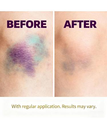 Guliqi Arnica Montana Relief Cream - Extra Strength for Fast Soothing of Bruises Swelling & Muscle Discomfort - Hydrating Non-Greasy Formula with Natural Ingredients -4.23oz (120g) (1) - Buy Online on GoSupps.com