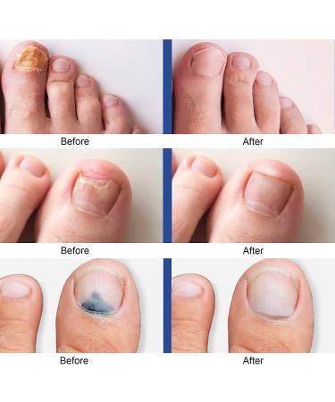 Fungus Nail Treatment - Extra Strength Toenail & Fingernail Repair Solution - Buy Online on GoSupps.com