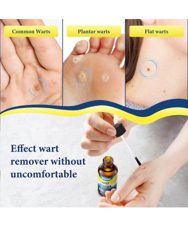 Maximum Strength Wart Remover with Salicylic Acid - Fast-Acting Treatment for Plantar Common & Flat Warts - Safe for Children & Adults - 30ml - Buy Online on GoSupps.com