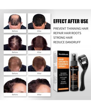 JITASHWA Hair Growth Spray Hair Regrowth Treatment Essence with Beard Growth Roller Hair Growth Serum for Repairing Hair Follicles Preventing Hair Loss Hair Thickening Products for Men & Women - Buy Online on GoSupps.com