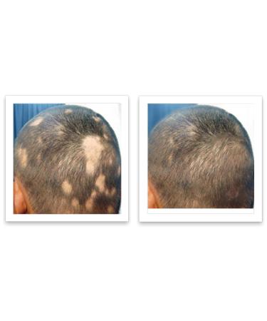 Caboki 10X Volumizing Hair Powder - Talc-Free Dark Gray | Root Touch Up for Thinning Hair | Cover Bald Spots for Men & Women - Buy Online on GoSupps.com