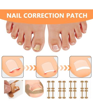 Landrain 105-Piece Ingrown Toenail Correction Set - Effective Treatment for Ingrown Toenails | International Shipping Available - Buy Online on GoSupps.com