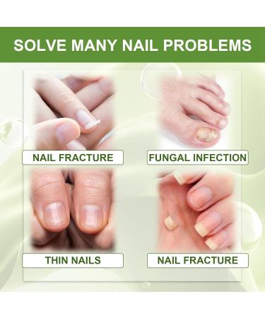 7 Days Nails Repairing Serum Nail Growth Treatment Nail Serum For Strength And Growth Toenail Strengthener For Damaged Nails Restores The Healthy Natural Appearance Of Nails (1) - Buy Online on GoSupps.com