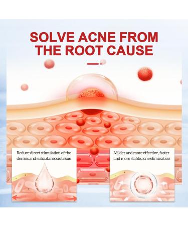 Tpubmity 25 g antiacne face cream acne removing gel antipimples immediate relief instantly cools and soothes reduces redness blue 25 g - Buy Online on GoSupps.com