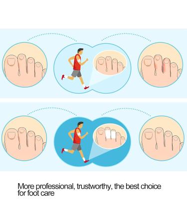 8 Pair Toe Spacer & Straightener Pads - Correct Hammer Toe & Curled Toes | International Shipping Available - Buy Online on GoSupps.com