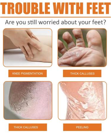 Foot Callus Removal Spray | Instant Peel Off for Cracked Heels & Dry Skin | Orange Oil Infused | Nourishing Foot Care (1PCS) - Buy Online on GoSupps.com