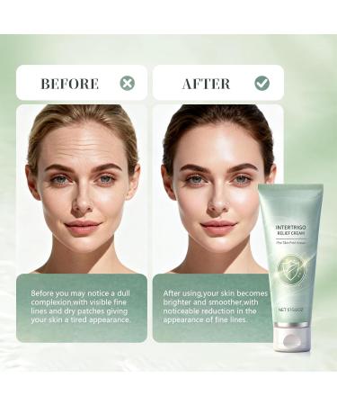 2PC Intertrigo Cream Skin Fold Care & Chafing Support Cream with Zinc Oxide & Undecylenic Acid Non-Steroid Formula to Soothe Irritated Skin & Reduce Moisture and Friction - Buy Online on GoSupps.com