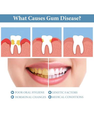 wimony Neslemy Gum Shield Therapy Gel Dentizen Gum Therapy Gel Gum Repair Treatment Gel Instant Teeth Whitening Essence Pen Deeply Cleaning Gums Teeth Whitening Enhances Overall Gum Health (4pcs) - Buy Online on GoSupps.com