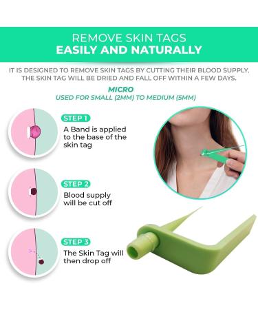Standard Skin Tag Tool Kit Quick Solution for Medium to Small Skin Tags Complete Skin Tag Tool Kit for Fast Results (2mm-5mm) - Buy Online on GoSupps.com
