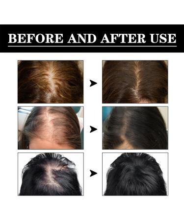 Hair Growth Serum For Hair Regrowth Hair Oil Anti Hair Loss Hair Loss Treatment For Women & Men 100% Natural Ingredients Hair Growth Treatment For Repairs Follicles & Thin Hair - Buy Online on GoSupps.com