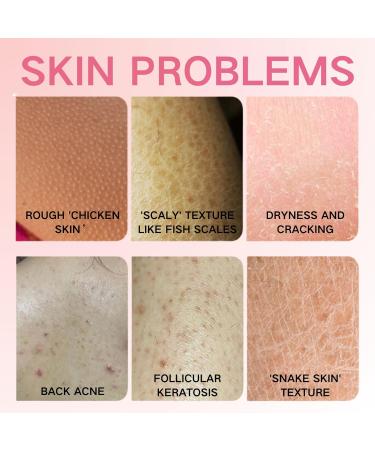 Keratosis Pilaris Improvement Body Cream - Body Moisturiser - Body Creams for Women - Firming Body Lotion for Soothing and Repairing - Dry Skin Moisturiser for Skincare - Nourishing & Moisturing - Buy Online on GoSupps.com