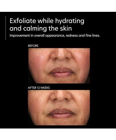 PCA SKIN Resurfacing Serum - Gentle Exfoliating Facial Corrective with Lactic & Glycolic Acid for Bright Even Skin | International Shipping Available - Buy Online on GoSupps.com