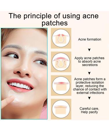 EUZUXU 40 Acne Patches Pimple Patch Waterproof Anti-Acne Pimple Patch Hydrocolloid Stickers for Pimples Invisible for Skin Care - Buy Online on GoSupps.com