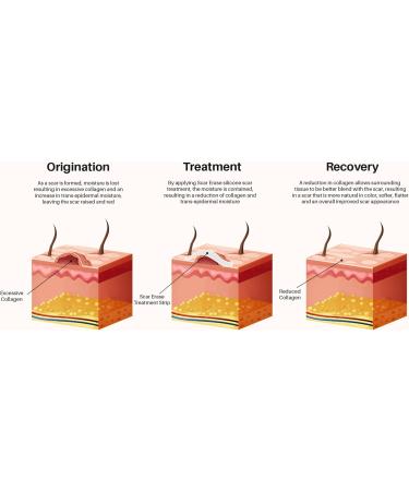 Scar Erase Silicone Scar Sheet Treatment - Soften & Flatten Surgery, Injury, Burns + C-Section Scars - 6 Week Medical Grade Strips (3cm x 15cm) - Buy Online on GoSupps.com