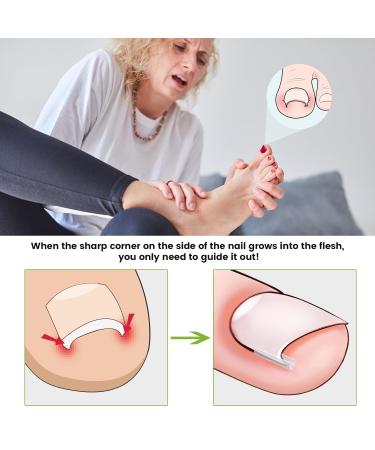 Bezox Ingrown Toenail Correction Set - 40 Pain-Free Smoothing Strips & Toe Nail Lifter - Effective Solution for Ingrown Toenails - Buy Online on GoSupps.com