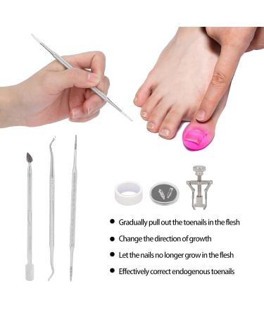 Shop Increased Toenail Corrector Set | Stainless Steel Ingrown Toenail Tools & Foot Care Solutions - Buy Online on GoSupps.com