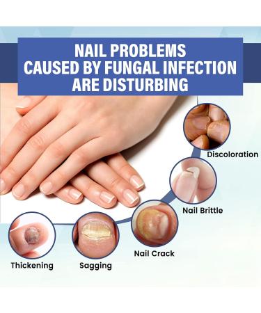 NailPro Nail Fungus LED Light Therapy Device Nail Fungus Laser Nail Fungus Treatment Home Use Nail-Fungus Remover for Toenail Fingernails & Onychomycosis (A01) - Buy Online on GoSupps.com