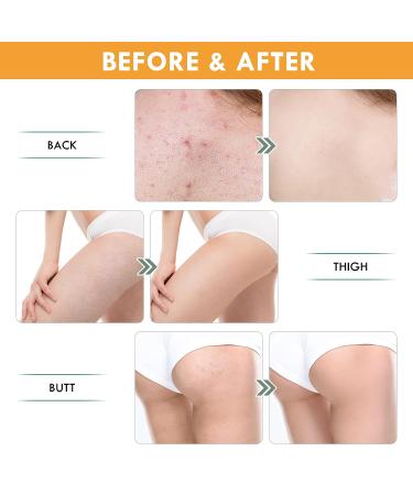 Acne Clearing Cream for Butt & Back | Salicylic Acid | Natural Ingredients | Fast Results - 120ml - Buy Online on GoSupps.com