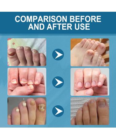 Nail Fungal Treatment Nails Essence Liquid Toenail Treatment Extra Strong Nail Repair Fingernail Toenail Care Fix Renew Damaged Broken Anti Fungus Nail Repair 30ML - Buy Online on GoSupps.com