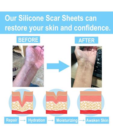 Silicone Scar Sheets 1.6 x 120 - Effective Scar Treatment Tape for Keloids Tummy Tuck & Surgical Scars - Premium Silicone Scar Strips - Buy Online on GoSupps.com