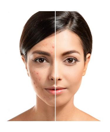 Blackhead Remover Acne Treatment Kit - Professional Skin Care Tools for Pimple Popper, Blemish, and Whitehead Extraction - 5 Piece Stainless Steel Set with Travel Case (Silver) - Buy Online on GoSupps.com